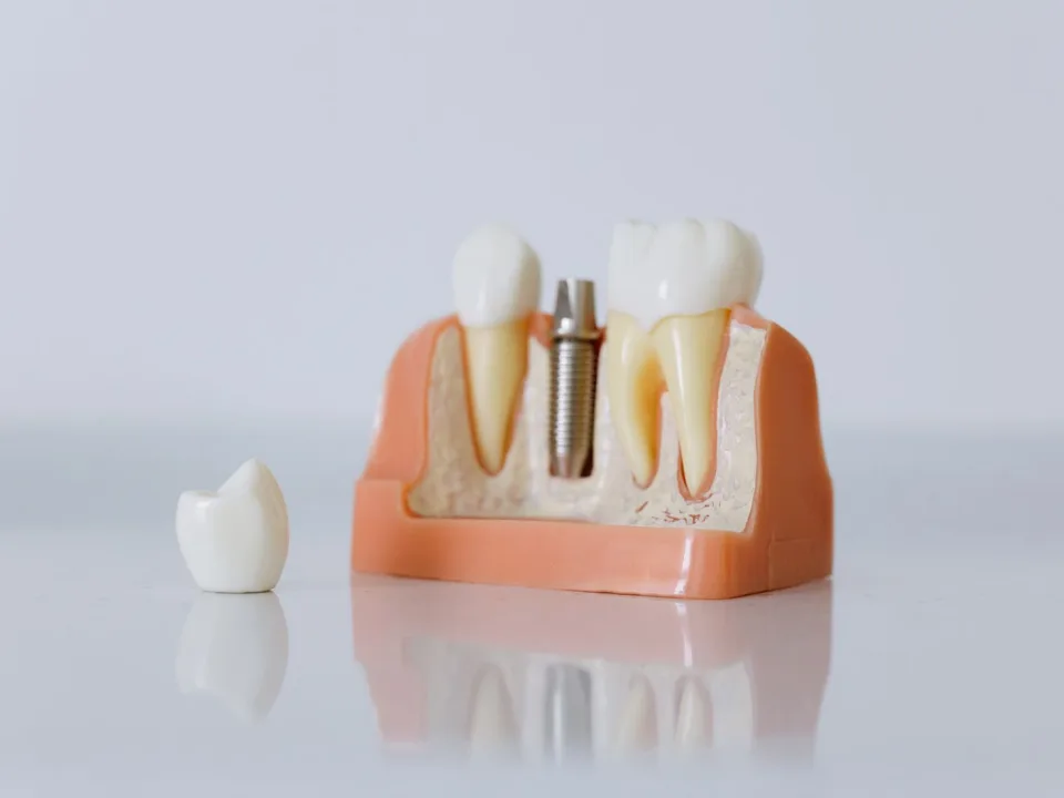 Çene kesiti modelinde titanyum implant ve porselen kron