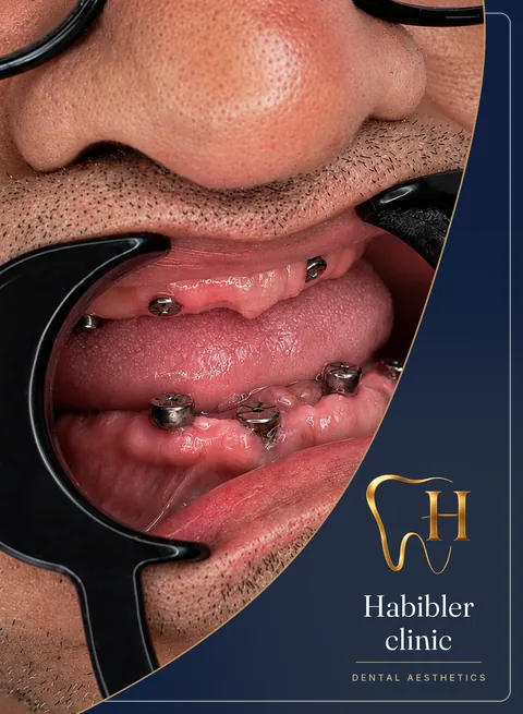 Full-arch implant restoration — during treatment, implants in place