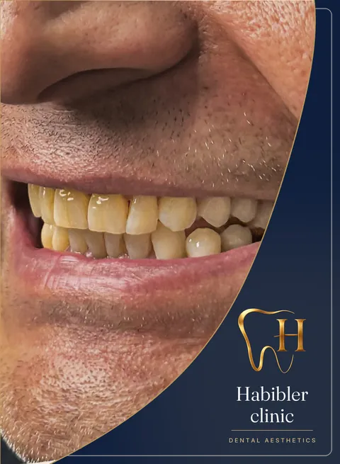 Smile makeover — before, smile — side view