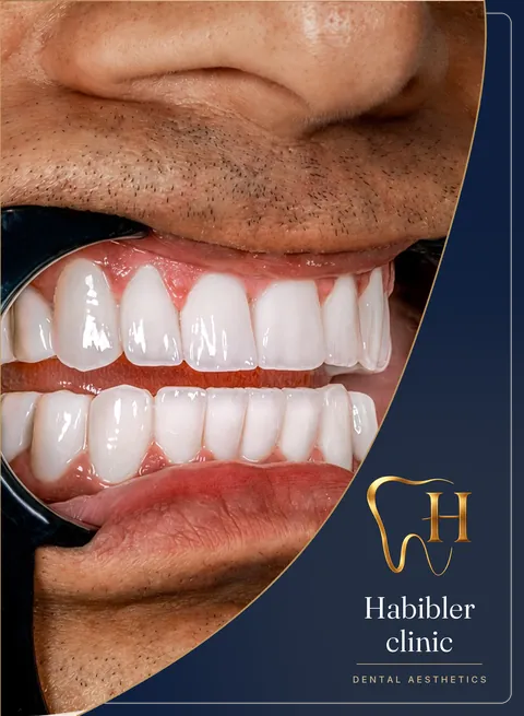 Smile makeover — after, side view