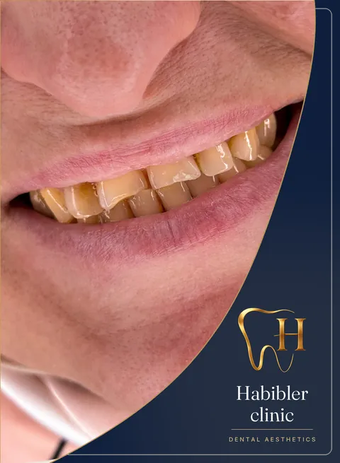 Smile makeover — before, smile