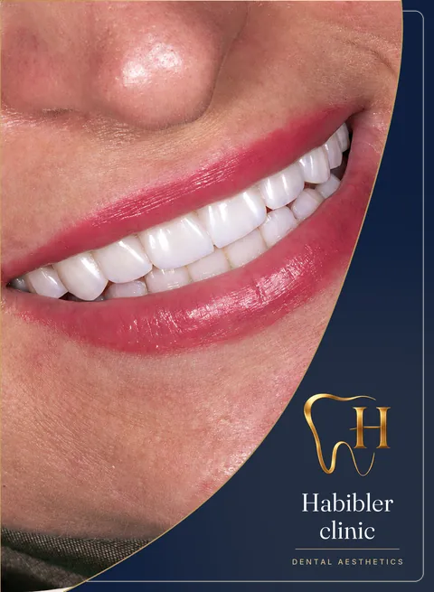 Smile makeover — after, smile